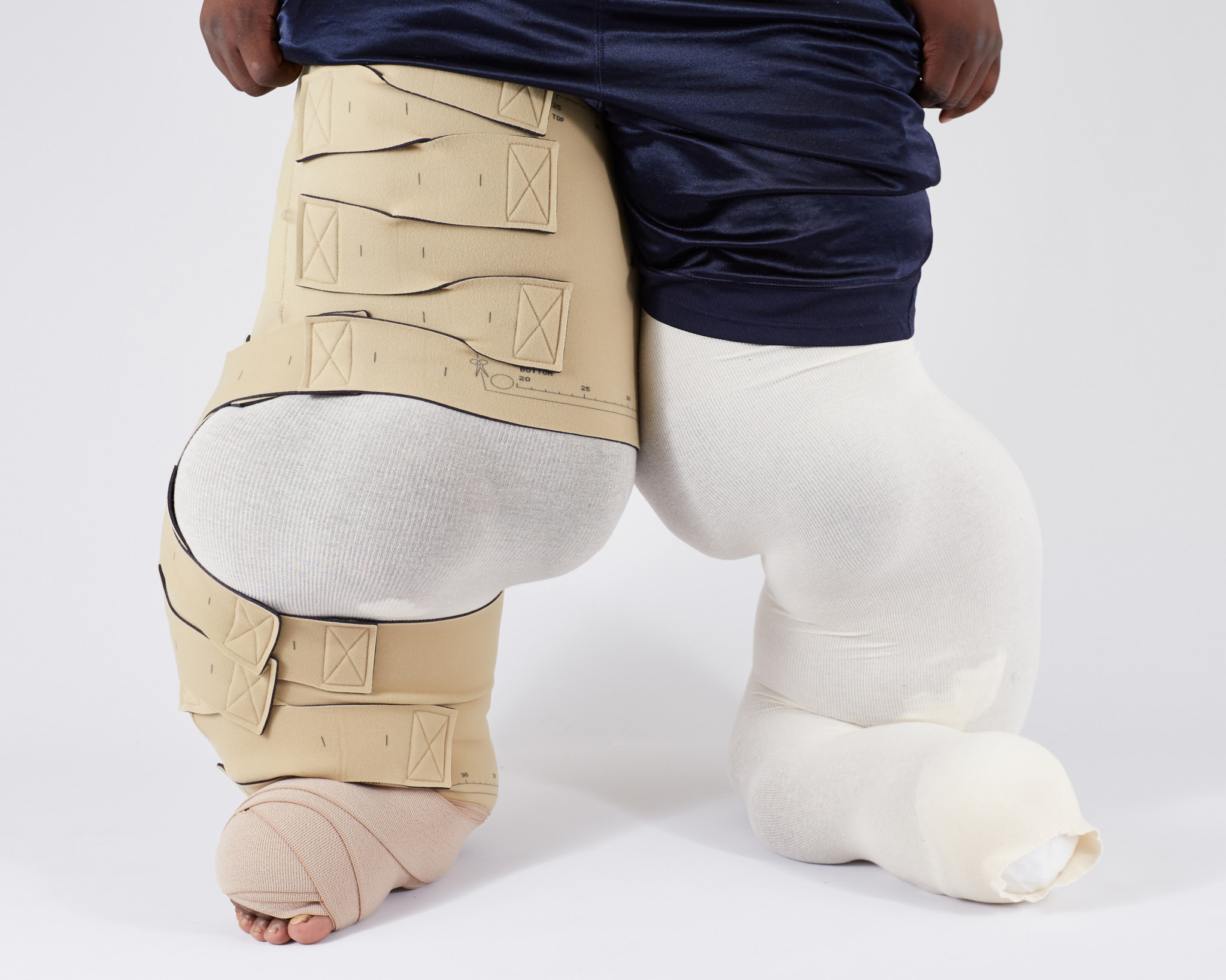 New lymphedema solutions from circaid Luna Medical